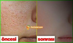 Yüzdeki Delikleri Geçirecek Maske ve Bakım Tavsiyeleri